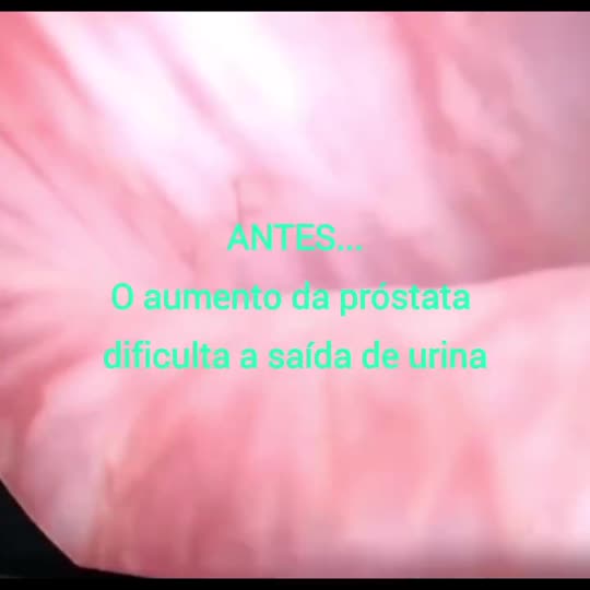 Pôster do vídeo: Próstata aumentada? Nem sempre é preciso cirurgia aberta